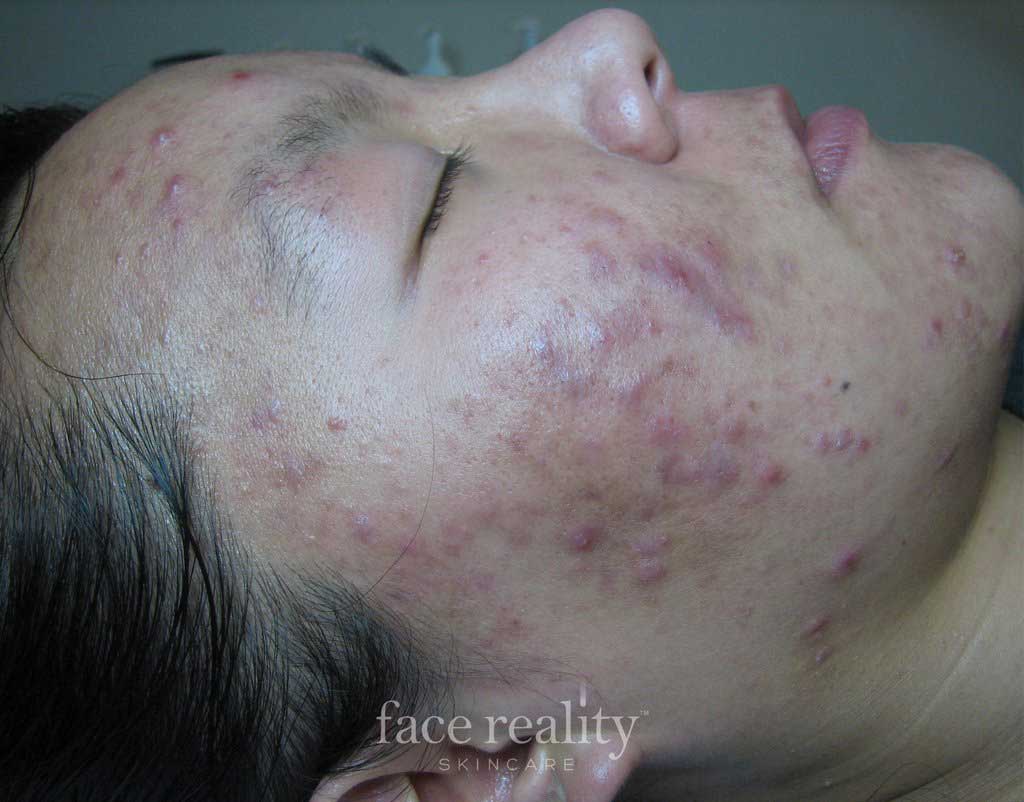 acne treatment face reality fresno advanced skin care
