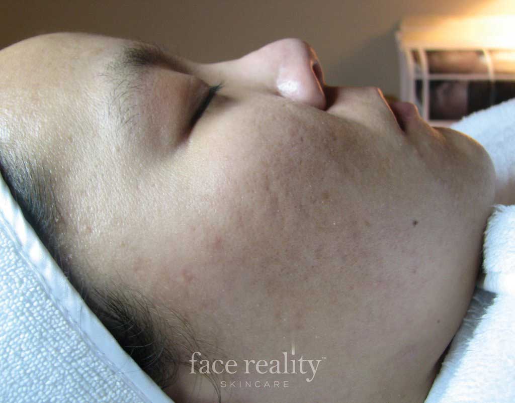 acne treatment, face reality fresno advanced skin care