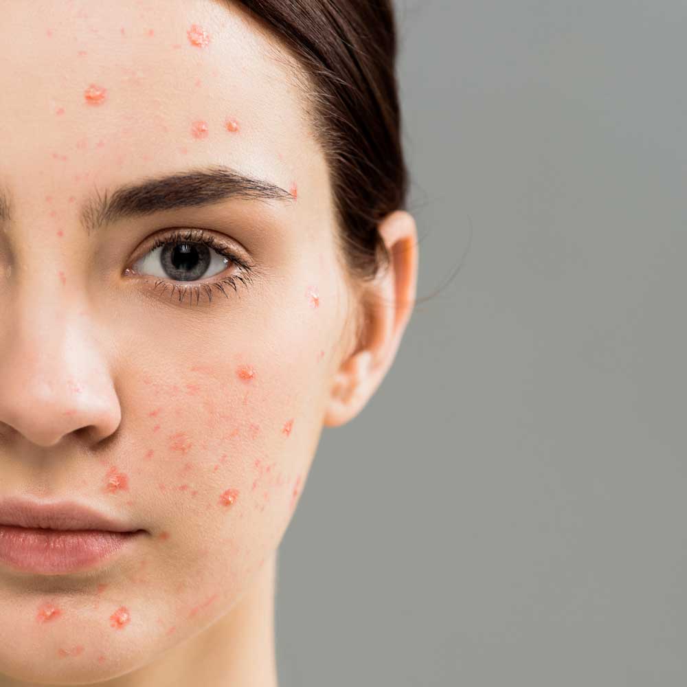 acne treatment fresno advanced skin care