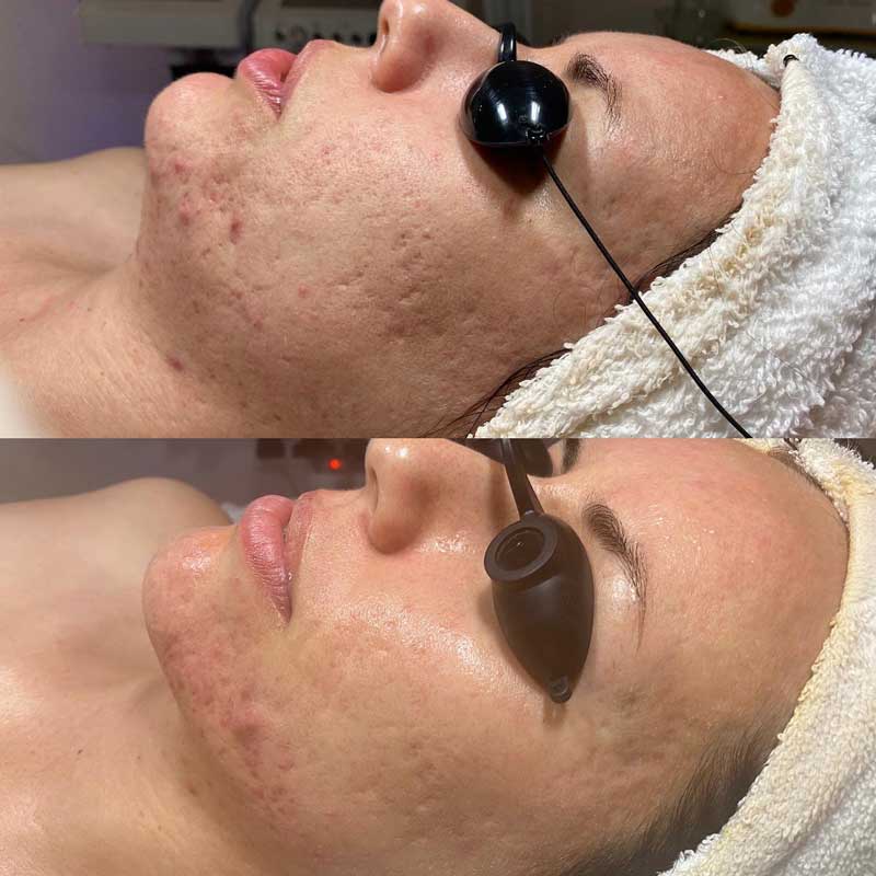acne-treatment-advanced-skin-care