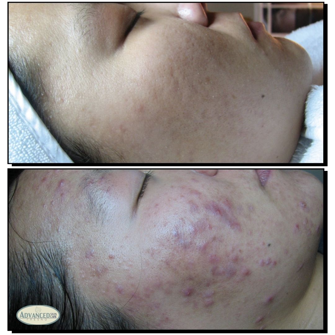 acne treatments before and after images