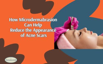 How Microdermabrasion Can Help Reduce The Appearance Of Acne Scars