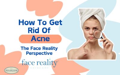 How To Get Rid of Acne: The Face Reality Perspective