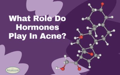 What Role Do Hormones Play in Acne