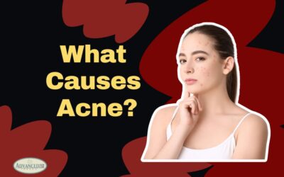 What Causes Acne?