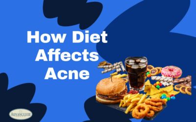 How Diet Affects Acne